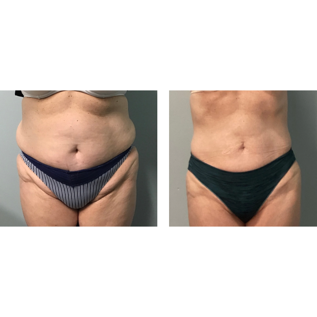 tirzepatide weight loss coastal virginia Fast and Safe Weight Loss with Semaglutide or Tirazepatide Injections