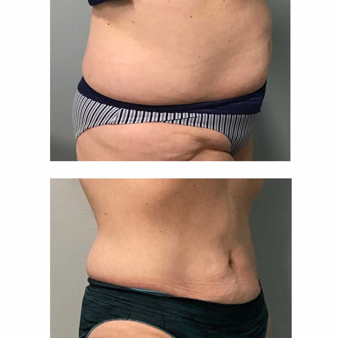 Fast and Safe Weight Loss with Semaglutide or Tirazepatide Injections | Riva MEDSPA Aesthetic Medicine & Wellness Fast and Safe Weight Loss with Semaglutide or Tirazepatide Injections | Riva MEDSPA Aesthetic Medicine & Wellness